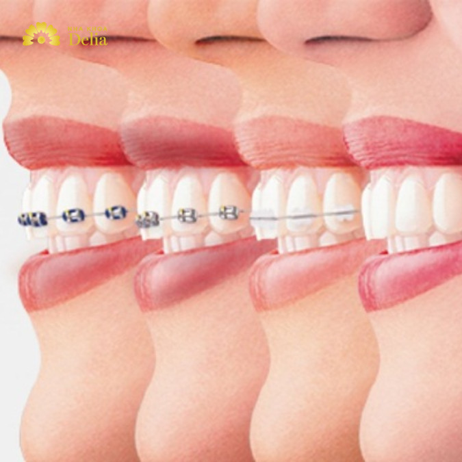 Niềng 3 răng bằng phương pháp nào tốt nhất 2024?