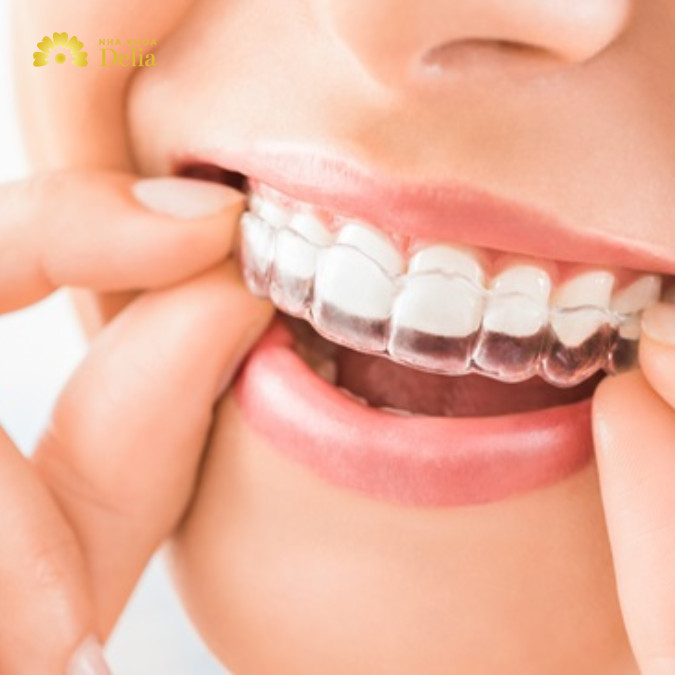 Niềng 3 răng là một thủ thuật nha khoa chuyên biệt, được thiết kế để chỉnh sửa và cải thiện vị trí của ba răng cụ thể trong hàm