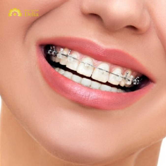 Niềng răng 1 hàm có hiệu quả không? Bác sĩ giải đáp