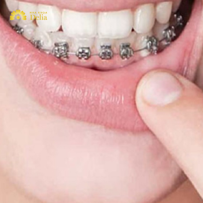 Niềng răng 1 hàm mất bao lâu thì răng đều, đẹp?