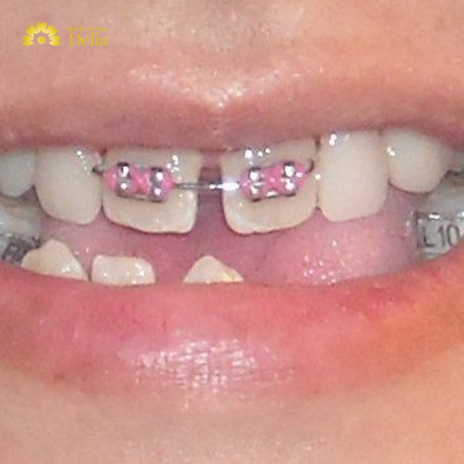 Niềng răng 2 cái là một quá trình chỉnh hình nha khoa được thiết kế để chỉnh sửa và cải thiện vị trí của hai chiếc răng cụ thể