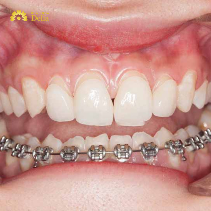 Chi phí niềng răng một hàm hiện nay dao động từ 20 đến 60 triệu đồng