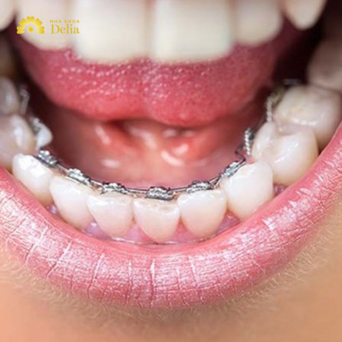 Niềng răng bên trong, còn được gọi là niềng răng mặt lưỡi hoặc niềng răng không nhìn thấy, là một phương pháp chỉnh nha trong đó các mắc cài và dây cung được gắn vào phía trong của răng, không nhìn thấy từ bên ngoài