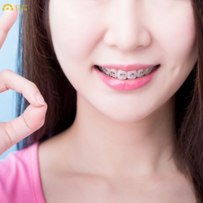 Niềng răng cho người có vòm hàm rộng