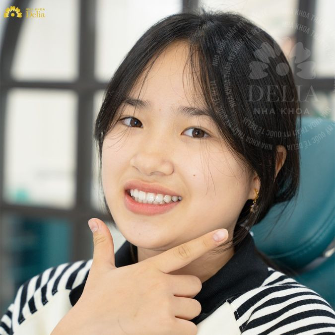 Đa số các trường hợp niềng răng đều cần nhổ răng để tạo khoảng trống cho việc sắp xếp lại các răng
