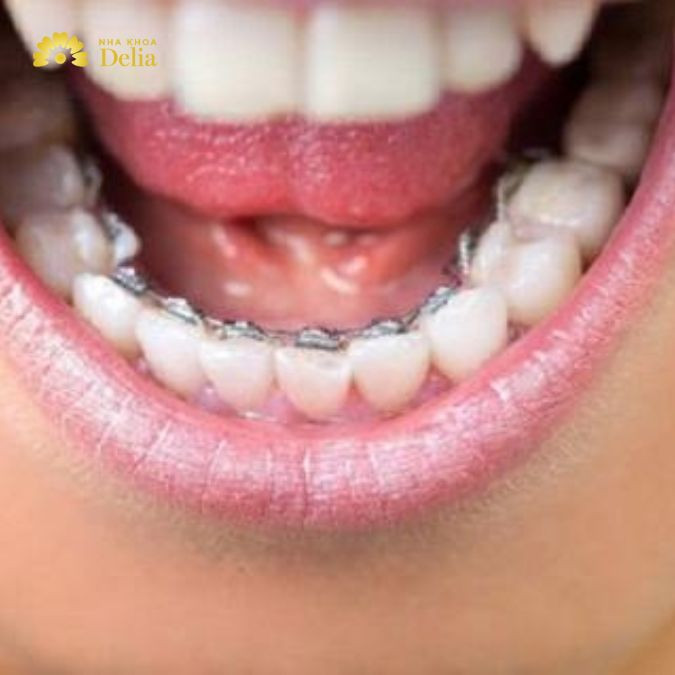 Niềng răng hàm dưới đặc biệt quan trọng vì nó không chỉ giúp cải thiện hình thức thẩm mỹ mà còn góp phần vào việc cải thiện chức năng ăn nhai