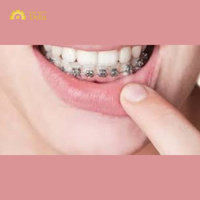 Thời gian niềng răng hàm dưới có thể dao động từ 12 đến 24 tháng