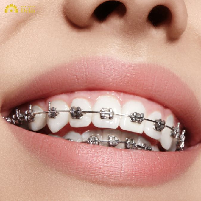 Một trong những nguyên nhân phổ biến dẫn đến tình trạng móm sau niềng răng là việc lựa chọn phương pháp niềng răng không phù hợp
