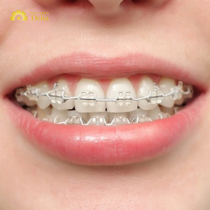 Niềng răng khểnh là một phương pháp chỉnh nha được thiết kế để điều chỉnh và cải thiện vị trí của các răng mọc lệch hoặc không đều