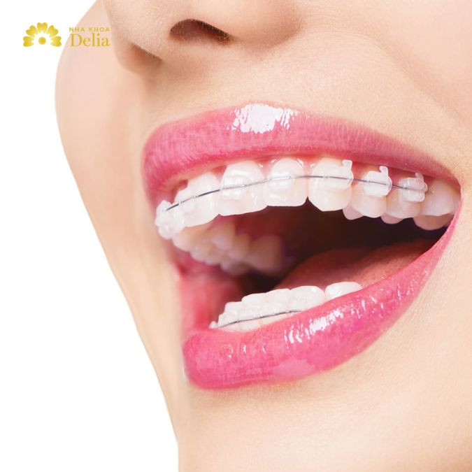 Bác sĩ giải đáp nhanh: Có nên niềng răng khôn không?
