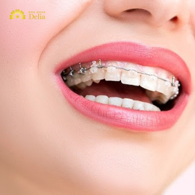 Niềng răng khớp cắn ngược là quá trình sử dụng thiết bị chỉnh nha để điều chỉnh và cải thiện tình trạng khớp cắn ngược, nơi răng hàm dưới cắn ra trước răng hàm trên.