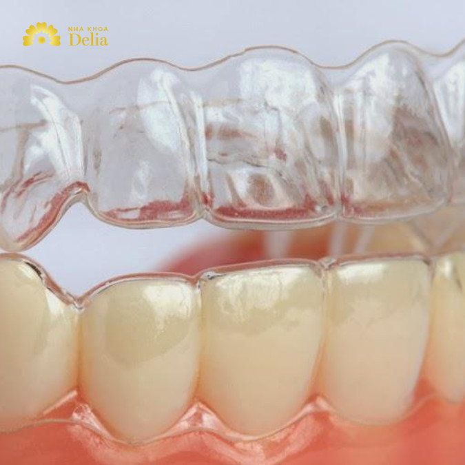 Phương pháp niềng răng trong suốt sử dụng các khay niềng trong suốt để điều chỉnh răng
