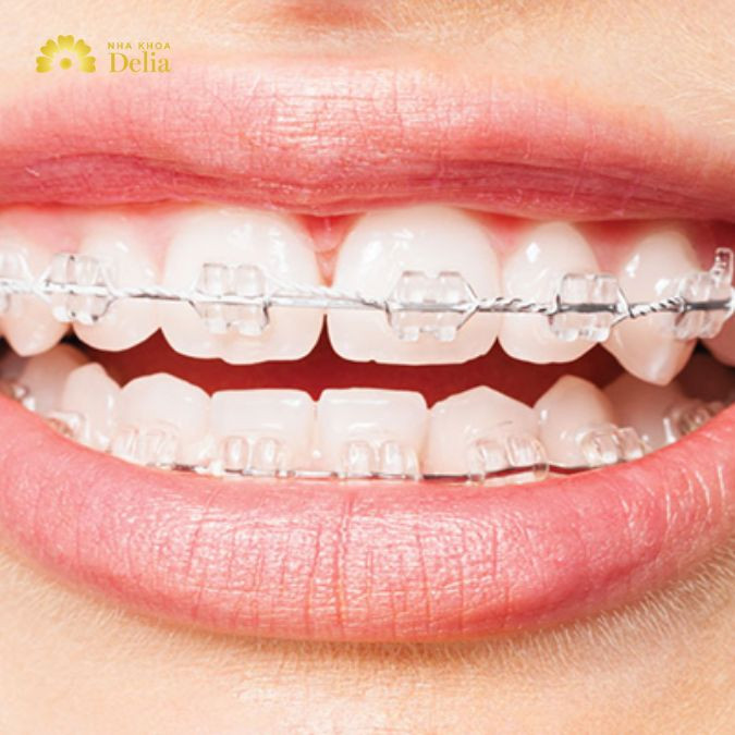 Niềng răng lần 2 là như thế nào, khi nào cần thực hiện?