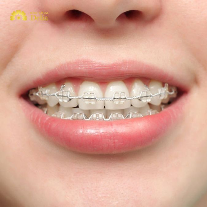 Niềng răng lần 2 là quá trình chỉnh nha được thực hiện sau khi đã hoàn thành một lần niềng răng trước đó