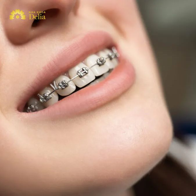 Niềng răng lần 2 cần chú ý nhiều vấn đề để đảm bảo quá trình điều trị diễn ra suôn sẻ và hiệu quả: