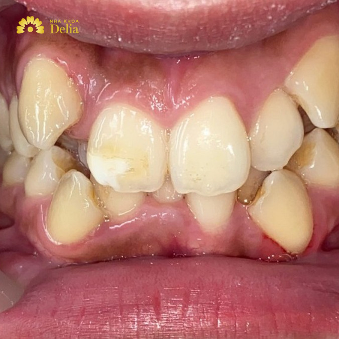 Niềng răng lệch hàm có được không, bao lâu có hiệu quả?