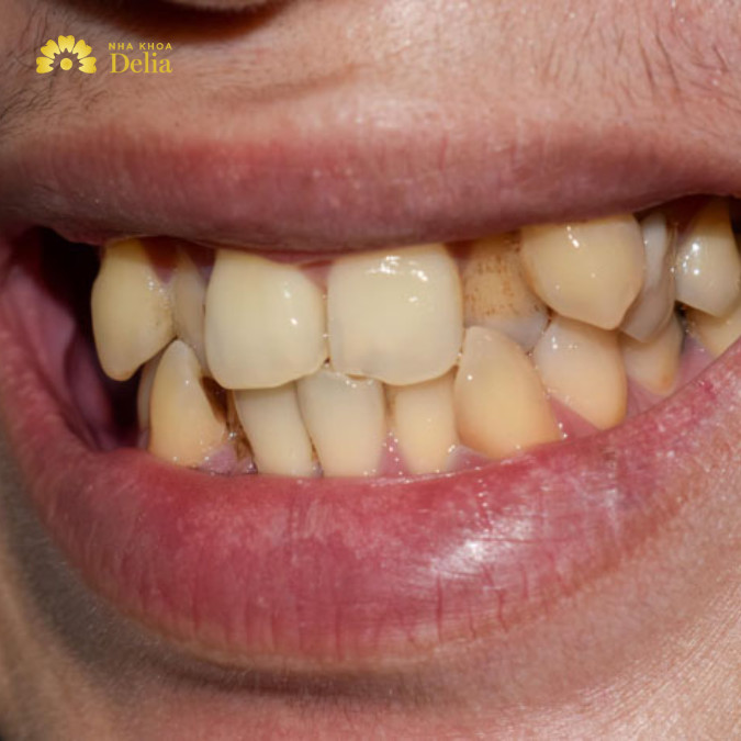 Lệch hàm xảy ra khi hàm trên và hàm dưới không khớp nhau một cách chính xác, gây ra các vấn đề về khớp cắn