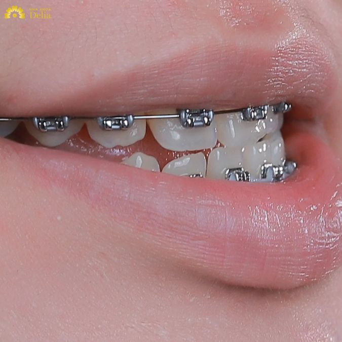 Nếu tình trạng răng móm của bạn không quá nghiêm trọng, khớp cắn giữa hai hàm không có sự chênh lệch lớn, thì bạn hoàn toàn có thể khắc phục mà không cần phải nhổ răng