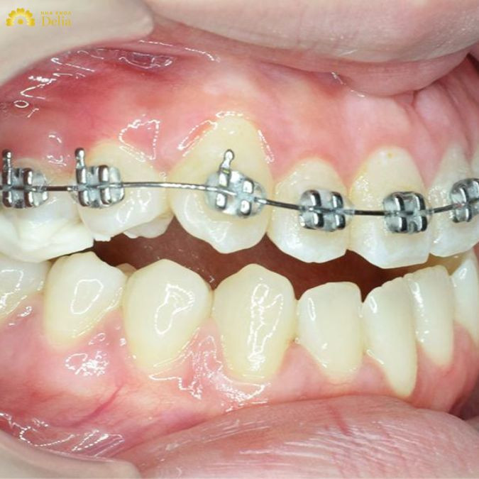 việc nhổ răng có thể được chỉ định tùy thuộc vào từng trường hợp cụ thể