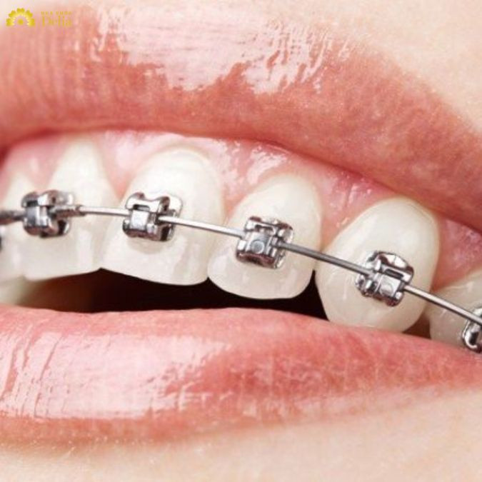 Niềng răng móm, đặc biệt là trong giai đoạn đầu, thường đi kèm với cảm giác hơi khó chịu khi cơ miệng chưa quen với lực tác động của mắc cài