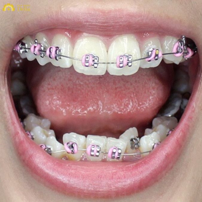 Khí cụ này giúp mở rộng cung hàm nhưng cũng có thể gây cảm giác cồng kềnh và vướng víu