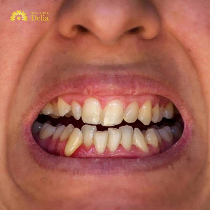 Niềng răng quặp là một quá trình điều trị nha khoa nhằm chỉnh sửa các răng mọc lệch lạc, chen chúc hoặc quặp lại với nhau