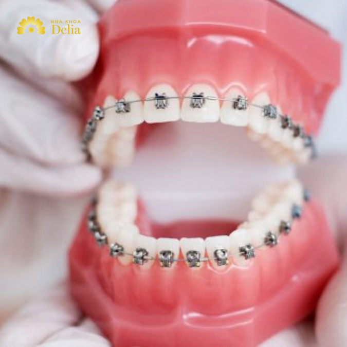 Việc niềng răng quặp có thể khá phức tạp và đòi hỏi một quá trình chuyên môn cao