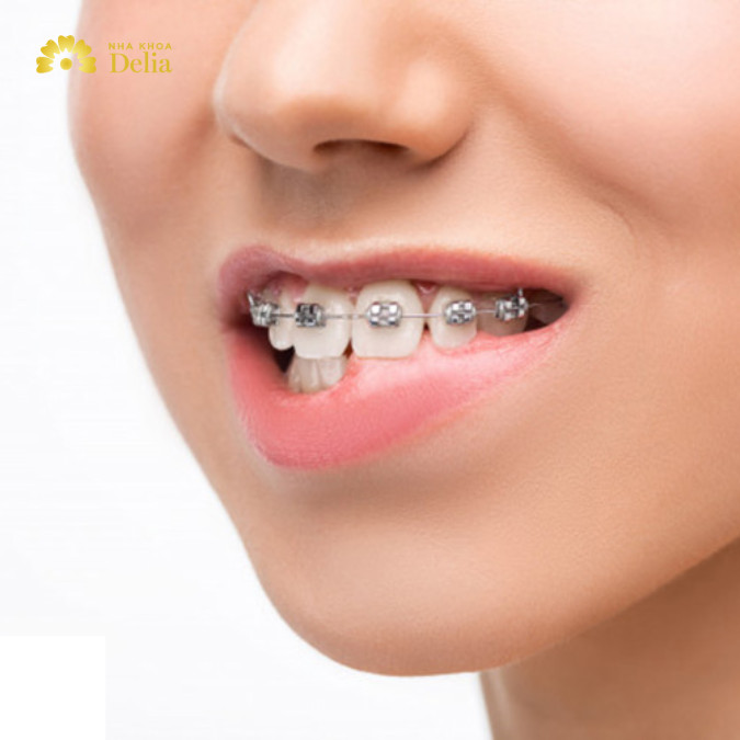 Niềng răng thưa bao nhiêu tiền 1 hàm, đắt hay rẻ?