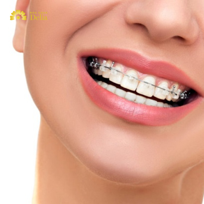 Niềng răng thưa một hàm là một phương pháp điều trị trong nha khoa nhằm chỉnh sửa tình trạng răng thưa trên một hàm răng, có thể là hàm trên hoặc hàm dưới.