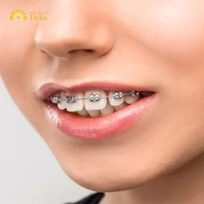 Niềng răng thưa 1 hàm có giá trung bình từ 15.000.000 - 60.000.000 triệu/liệu trình