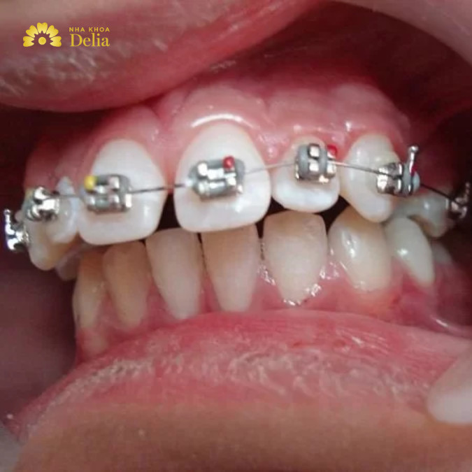 Việc có cần nhổ răng khi niềng răng thưa hay không phụ thuộc vào nhiều yếu tố cụ thể của từng trường hợp