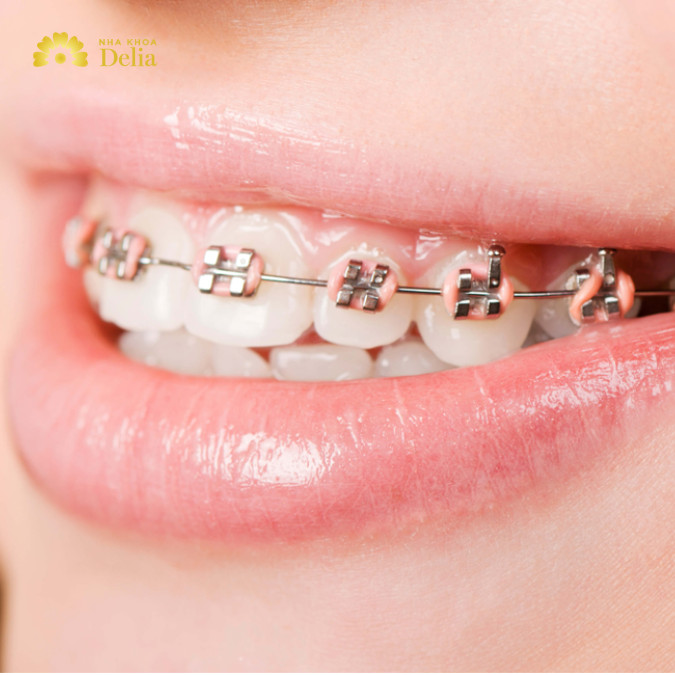 Niềng răng khấp khểnh là một quá trình chỉnh nha dùng để điều chỉnh và cải thiện tình trạng răng mọc không đều, răng có khoảng cách lớn hoặc không đồng đều trong hàm.