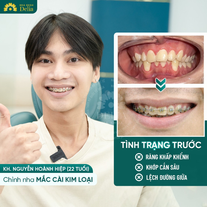 Niềng răng là một quá trình dài và đòi hỏi sự chính xác cao, bắt đầu từ việc cài đặt thiết bị chỉnh nha và tiếp tục với việc quản lý và điều chỉnh định kỳ