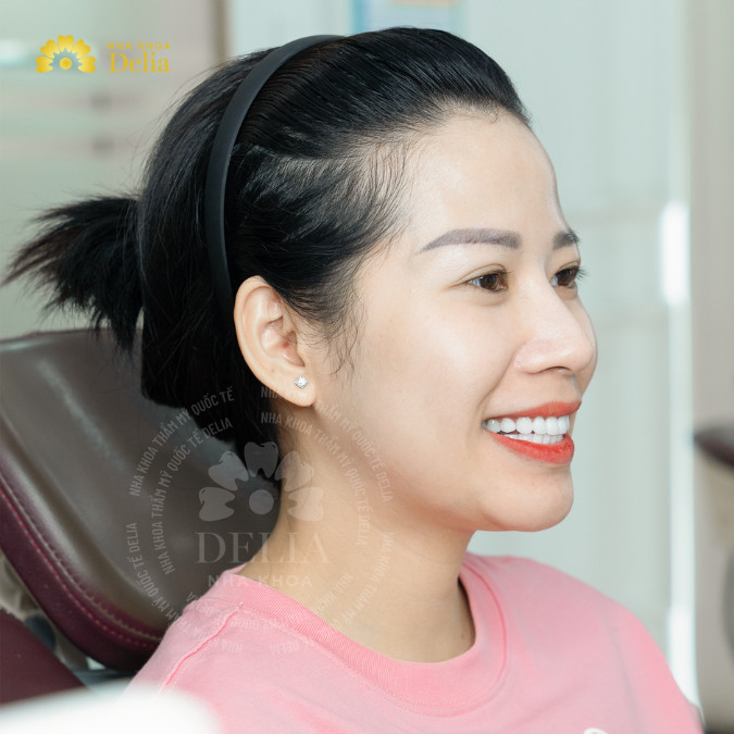 Quá trình đeo mắc cài kim loại diễn ra suôn sẻ và tôi bắt đầu nhìn thấy sự thay đổi rõ rệt sau chỉ 6 tháng - Chị Phương