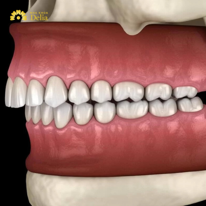 Quy trình niềng răng khớp cắn sâu chuyên nghiệp từng bước