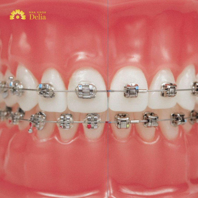 Đối với mắc cài kim loại hoặc sứ, bác sĩ sẽ gắn chúng trực tiếp lên mặt trước của răng bằng một loại keo đặc biệt.