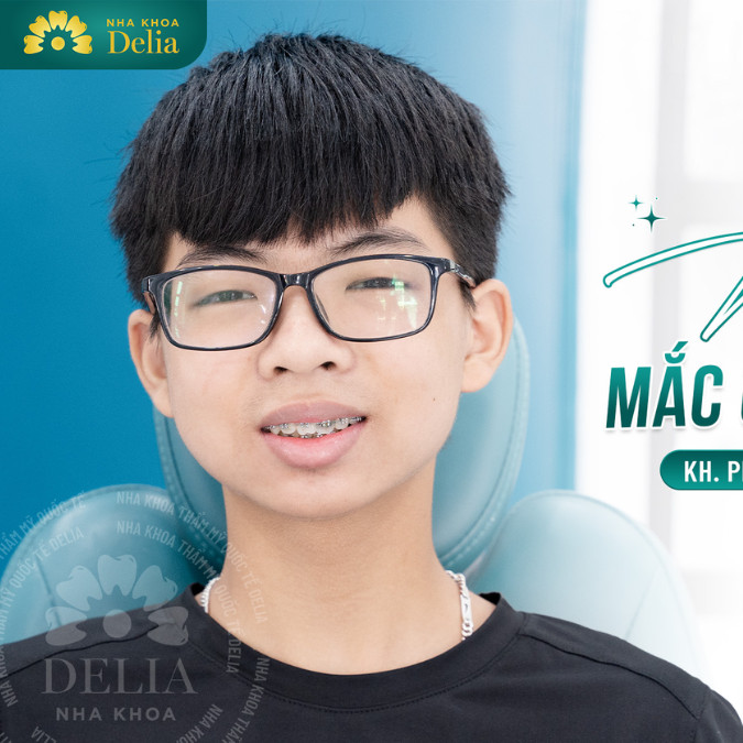 Bác sĩ tại Delia đã rất tận tình giải thích rõ ràng quy trình và lựa chọn mắc cài kim loại cho em, giúp em cảm thấy thoải mái hơn khi giao tiếp Em Phương