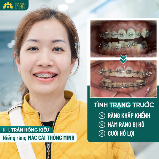 Các bác sĩ tại Delia đã theo sát tiến trình điều trị của tôi, đảm bảo rằng mỗi giai đoạn diễn ra suôn sẻ.