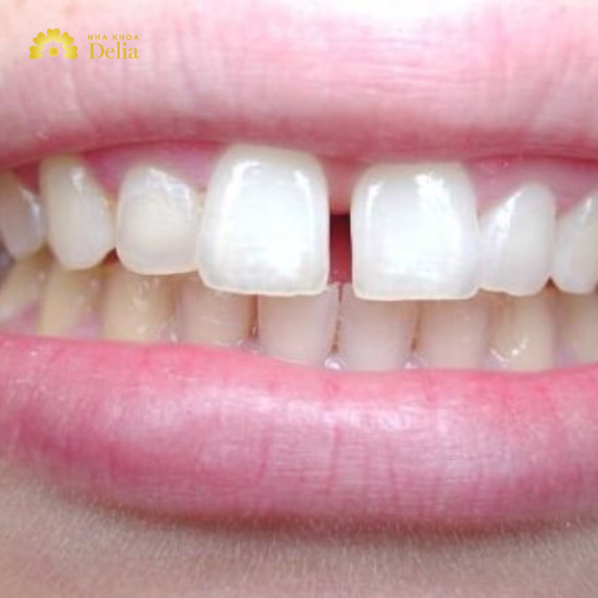 Khi răng bị thưa sau khi niềng, điều này có thể ảnh hưởng đáng kể đến nụ cười và tổng thể thẩm mỹ của khuôn mặt