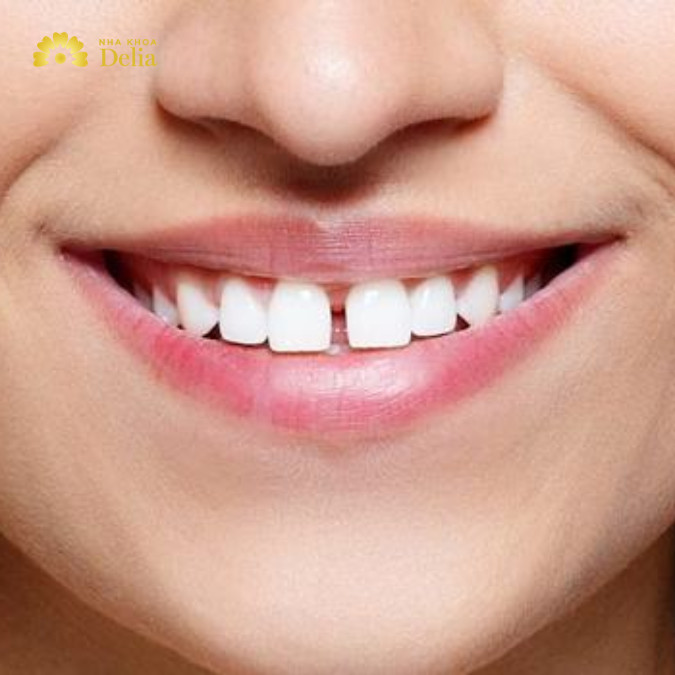 Khi răng bị mất mà không được điều trị kịp thời, các răng còn lại có thể di chuyển và tạo ra khoảng trống.