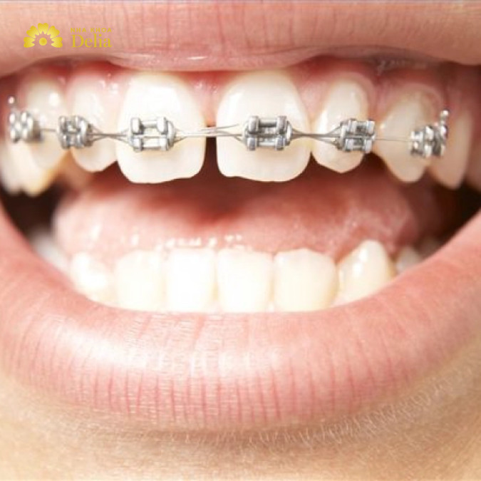 Phương pháp niềng răng mắc cài kim loại có ưu điểm về chi phí thấp hơn nhiều so với các kỹ thuật chỉnh nha khác