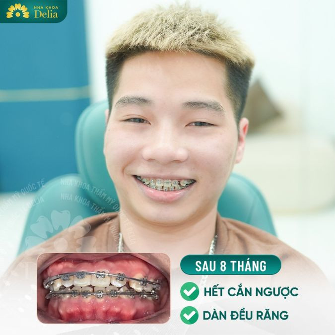 Với răng yếu ở mức độ nhẹ, việc niềng răng vẫn có thể thực hiện được, tuy nhiên yêu cầu kỹ thuật cao hơn và cần có kế hoạch điều trị cụ thể