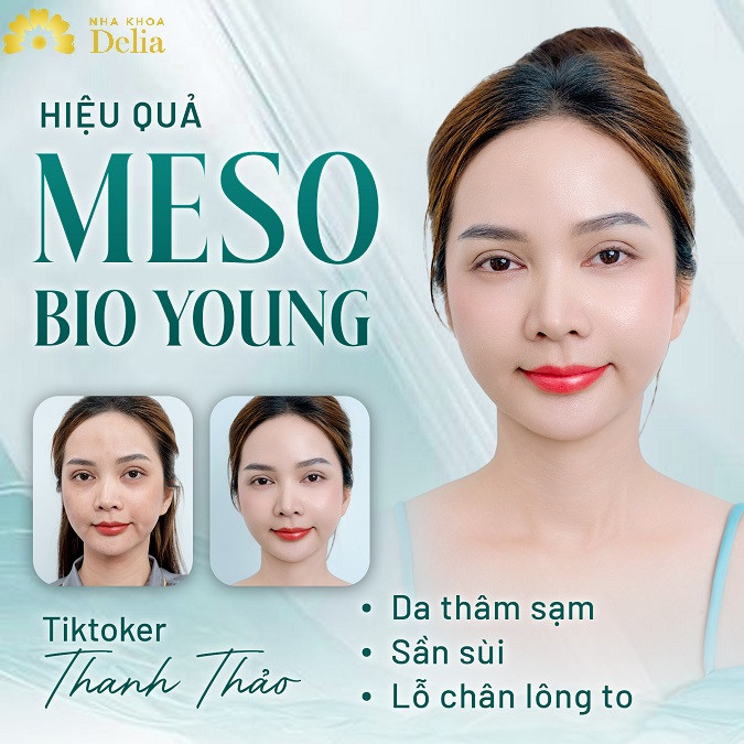 Gói tái sinh nhan sắc hỗ trợ dịch vụ tiêm Meso Bio Young giá ưu đãi