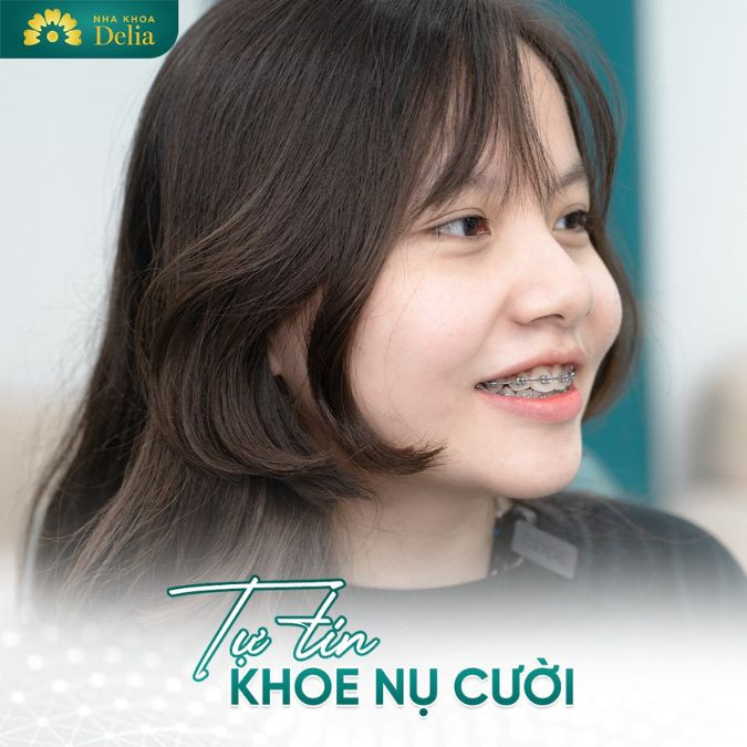 Bạn Linh - Học sinh lớp 10 tự tin hơn với hàm răng mới