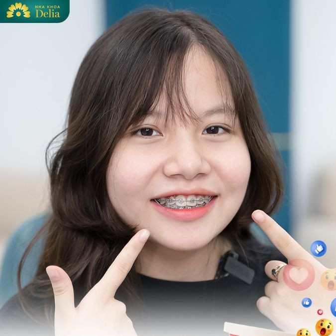 Sau khi niềng răng móm, bạn sẽ nhận thấy rõ rệt sự thay đổi tích cực trên khuôn mặt
