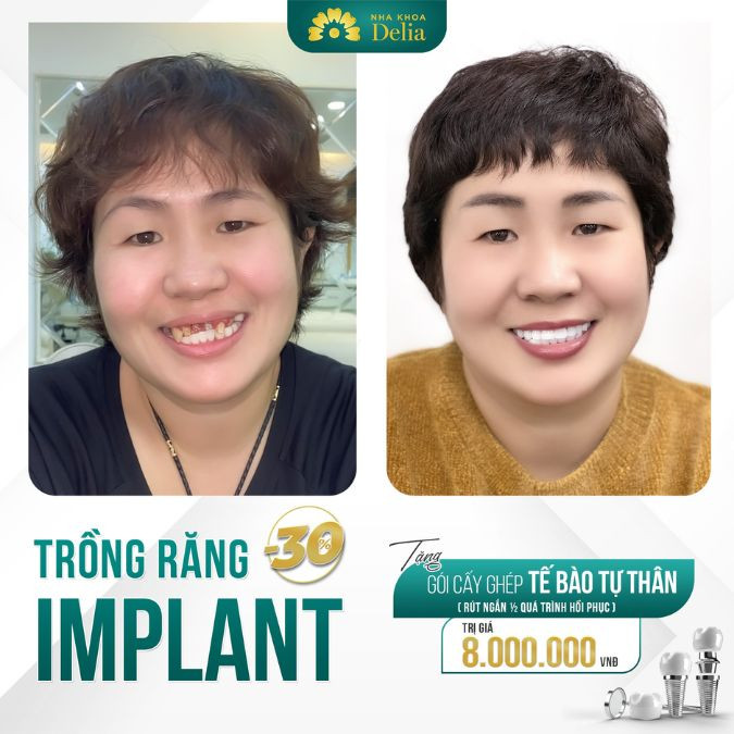 Trồng răng cửa Implant giá bao nhiêu?