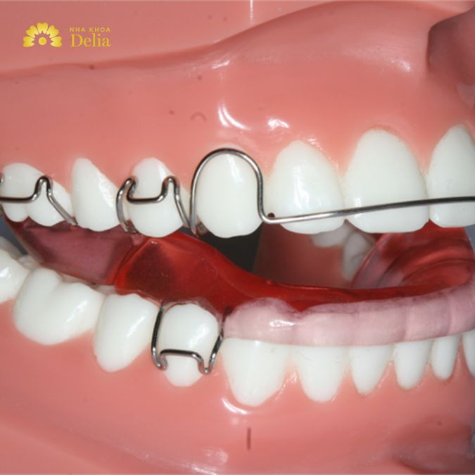 Người trưởng thành cần đeo hàm tháo lắp khoảng 6 - 12 tháng