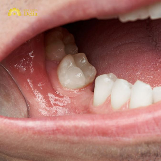 Hàm tháo lắp không thể ngăn ngừa tiêu xương do mất răng