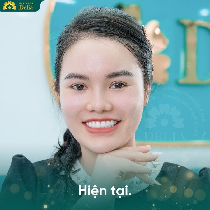 Sau khi làm hàm tháo lắp trên implant tại nha Khoa Delia, tôi cảm thấy rất hài lòng.
