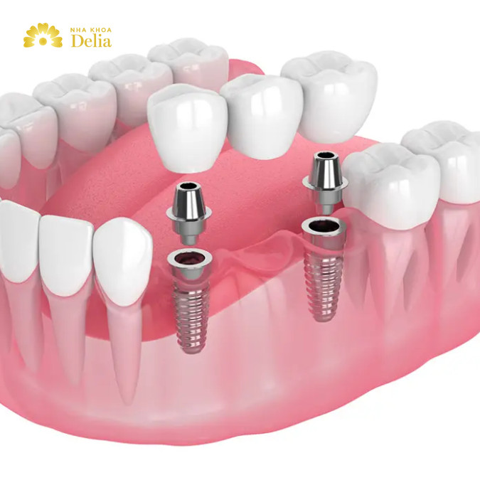 Trồng Implant được coi là giải pháp tối ưu vì nó không chỉ cung cấp độ bền và ổn định cao mà còn giúp bảo vệ và thúc đẩy sức khỏe xương hàm.